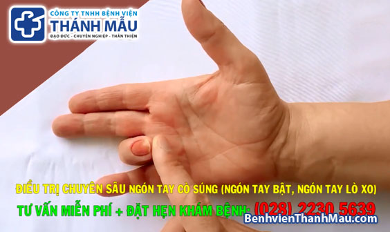 chữa ngón tay bật phẫu thuật ngón tay bật vật lý trị liệu ngón tay bật bấm huyệt ngón tay bật