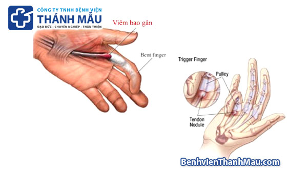 viêm gân gập ngón tay ngón tay cò súng ngón tay bật lò xo ngón tay lò xo - bệnh viện thánh mẫu 118 bành văn trân