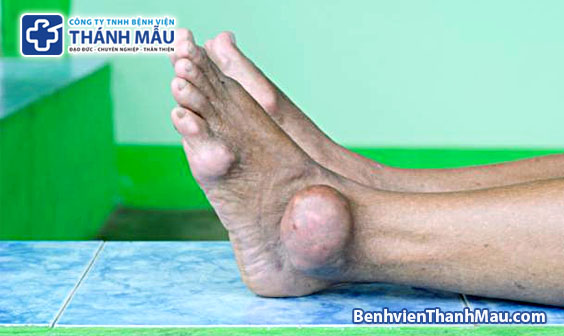 bệnh gout biến chứng bệnh gout