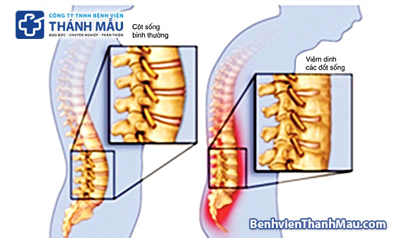 viêm cột sống dính khớp là gì