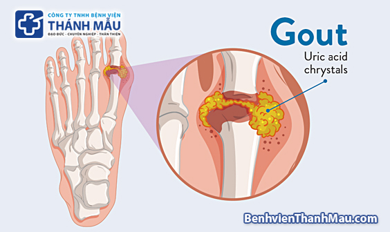 bệnh gout bệnh gút chữa bệnh gout tphcm