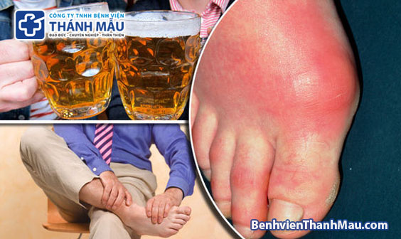 bệnh gout nên kiêng gì chữa bệnh gout tphcm