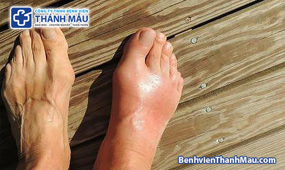 bệnh gout triệu chứng bệnh gút triệu chứng