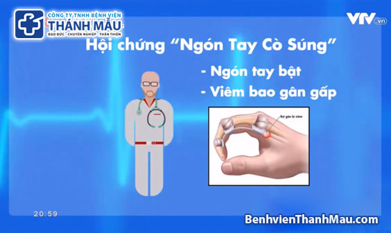 ngón tay cò súng ngón tay bật ngón tay lò xo bệnh viện thánh mẫu