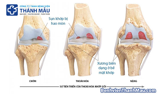 thoái hóa khớp gối thoái hóa khớp chữa thoái hóa khớp gối