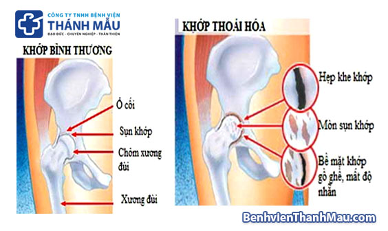 thoái hóa khớp háng là gì thoái hóa khớp