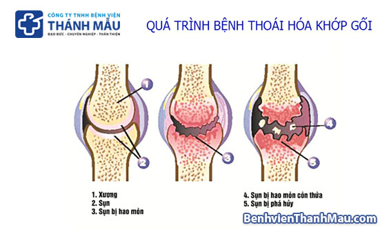 thoái hóa khớp thoái hóa khớp là gì