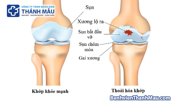 thoái hóa khớp hình ảnh thoái hóa khớp gối