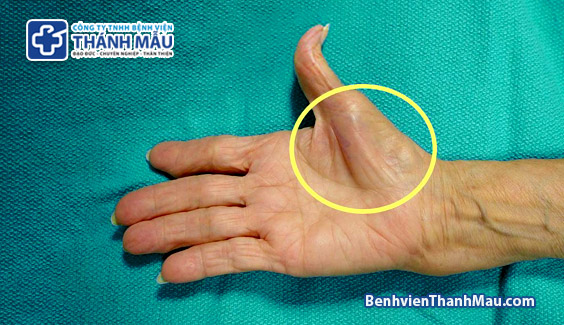 bien chung hoi chung ong co tay carpal tunnel syndrome complications